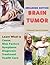Brain Tumor: Learn What Is Cause, Risk Factors, Symptoms, Diagnosis, Treatment and Health Care (Illustrated)