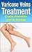 Varicose Veins Treatment