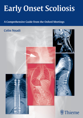 Early Onset Scoliosis: A Comprehensive Guide from the Oxford Meetings (Hardcover)