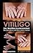 VITILIGO - Die Weißfleckenkrankheit: Was Betroffene und Ärzte wissen müssen (German Edition)