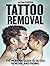 Tattoo Removal: the Modern ...
