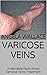 Varicose Veins: Undeniable Facts About Varicose Veins Treatment