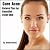Cure Acne by Debbie Butler