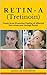 RETIN-A (Tretinoin): Treats...