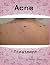 Acne Treatment