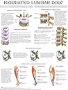 Herniated Lumbar Disk - Quick Reference Chart: Full illustrated
