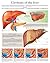 Cirrhosis of the liver e-chart: Full illustrated