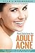 Real Solutions for Adult Acne: The Essential Guide to Clear Skin for Life
