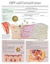 HPV and Cervical Cancer e-chart: Full illustrated