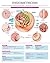 Endometriosis e chart: Full...