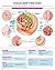 Endometriosis e chart: Full illustrated