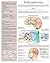 Schizophrenia e chart: Full illustrated