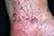 Skin Disease
