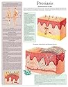 Psoriasis e-chart: Full illustrated