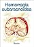 Miniatlas Hemorragia subaracnoidea (Spanish Edition)