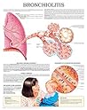 Bronchiolitis e chart: Full illustrated