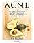 Acne: Acne Treatment: Acne Removal: Acne Remedies For Clear Skin (Acne Skin Care Treatments From Diet & Medical Treatments To All Natural Remedies Including Diet & Scar Removal For Clear Skin)