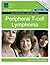 Peripheral T-cell Lymphoma