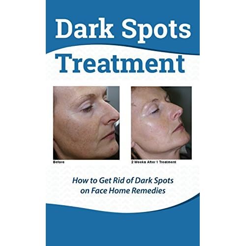 Dark Spots Treatment How To Get Rid Of Dark Spots On Face Home Remedies By Tatum Spence