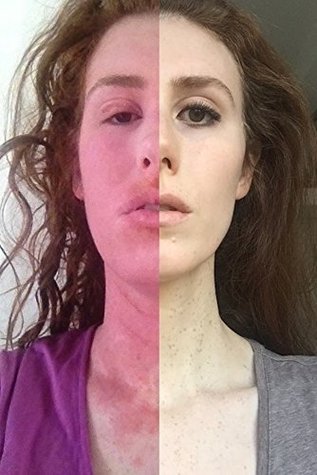 Curing My Incurable Eczema By Cara Ward