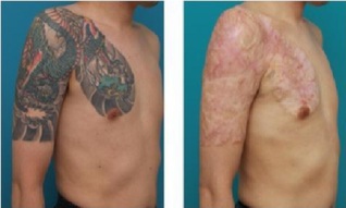How To Remove Tattoos Naturally | Very Easy To Removal