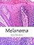 Melanoma