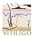 Vitiligo: A Step-By-Step Gu...