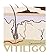 Vitiligo by Yan Valle
