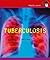 Tuberculosis