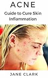 ACNE: Guide to Cure Skin Inflammation ACNE: Guide to Cure Skin Inflammation