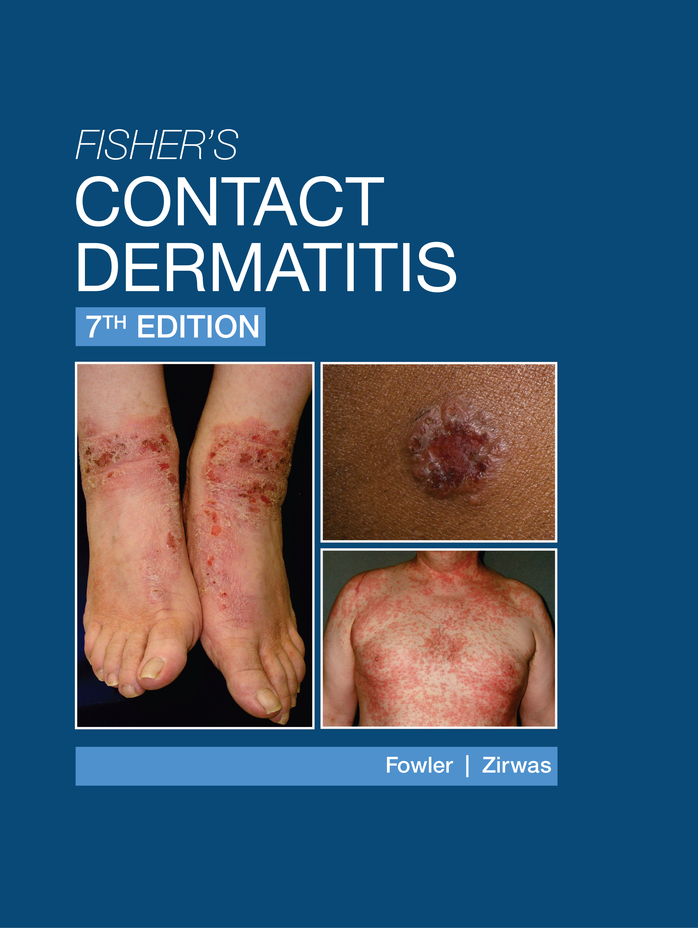 Fisher's Contact Dermatitis - 7th Edition by Alexander Fisher