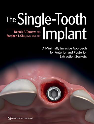 The Single-Tooth Implant:: A Minimally Invasive Approach for Anterior and Posterior Extraction Sockets (Kindle Edition)