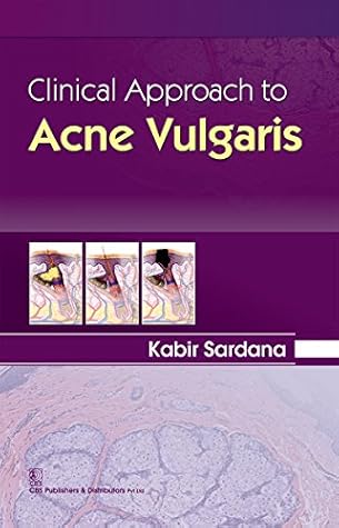 Clinical Approach to Acne Vulgaris