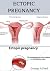 ECTOPIC PREGNANCY