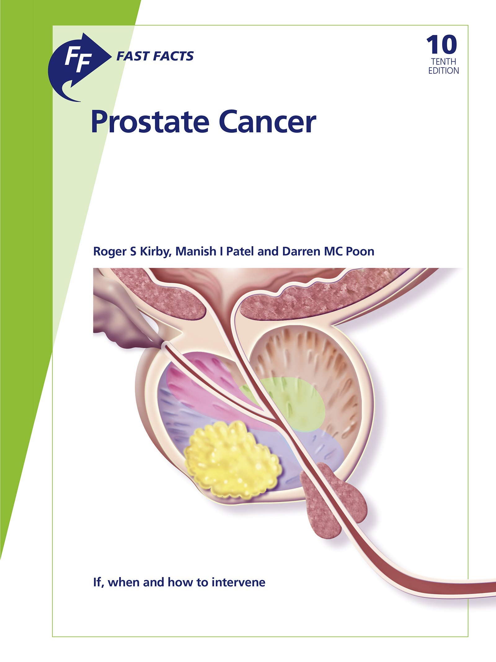Fast Facts: Prostate Cancer: If, when and how to intervene (Kindle Edition)