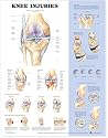 Knee Injuries Anatomical Chart by Anatomical Chart Company, ACC