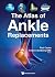Atlas Of Ankle Replacements...