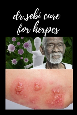 dr.sebi cure for herpes: Treat all types of herpes naturally and in the shortest time with Doctor SEBI