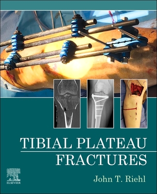 Tibial Plateau Fractures - E-Book