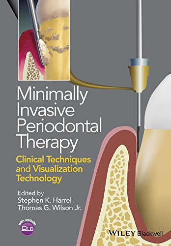 Minimally Invasive Periodontal Therapy: Clinical Techniques and Visualization Technology by Stephen K. Harrel, Wiley-Blackwell