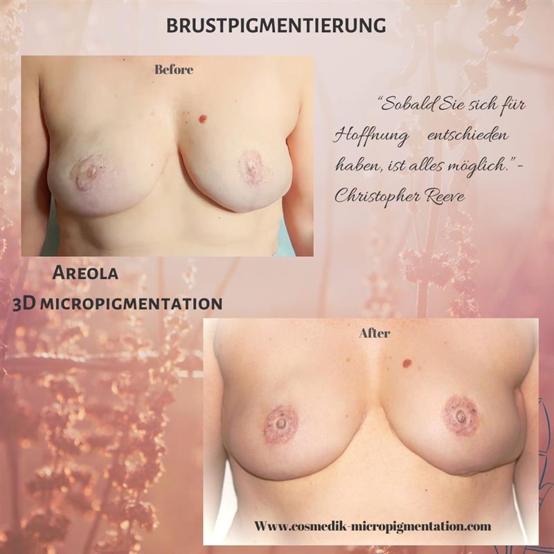 Breast micropigmentation