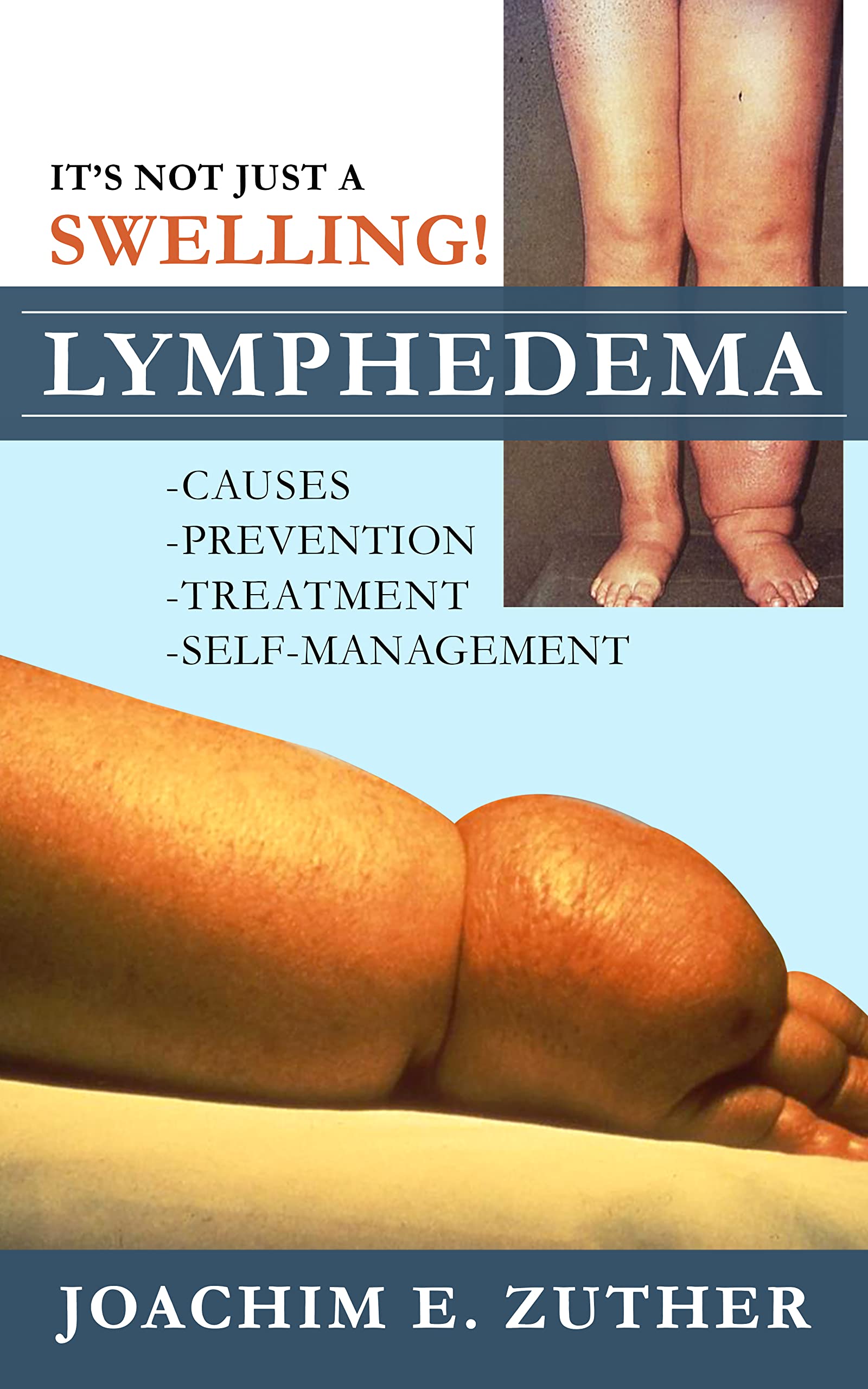 It's Not Just a Swelling! Lymphedema: Causes, Prevention, Treatment, Self-Management (Kindle Edition)