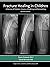 Fracture Healing in Children: A Review of Pediatric Osseous Modeling and Remodeling Second Edition