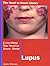 Everything You Need to Know About Lupus (Need to Know Library)