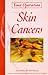 Skin Cancers