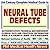 21st Century Complete Medical Guide To Neural Tube Defects, Anencephaly, Cephalic Disorders, Chiari Malformation, Encephaloceles, Hydraencephaly, And Related ... For Patients And Physicians (Cd Rom)