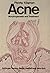 Acne: Morphogenesis and Treatment