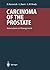 Carcinoma of the Prostate: ...