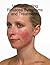 Understanding Rosacea Symptoms and Treatments by Robert Gross