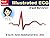 Illustrated ECG: (Fast Review)